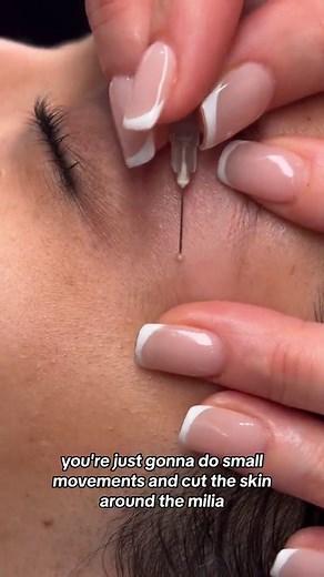 Proper Milia Removal Techniques