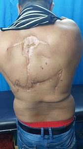 835K views · 7.5K reactions | Sarcoma Recurrent common, Radiotherapy and Chemotherapy little role, Strictly follow up | Cancer Care by Dr.Salam | Facebook