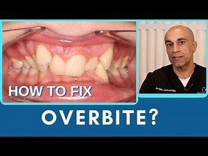 How to Fix Overbite with Braces or Invisalign®?