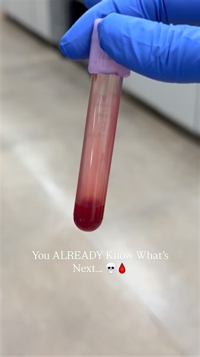 Marilyn | CLS MLS(ASCP) | Underfilling a tube isn’t just a minor mistake… it can wreck patient results. 🩸 Lavender tops contain EDTA measured for a full draw. Too... | Instagram