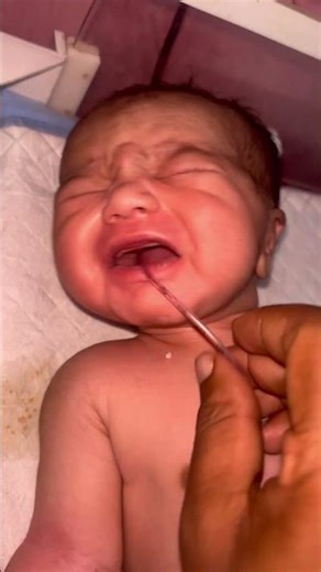 How an NG Tube Is Quickly Placed for a Newborn Baby (NICU Care) #NewbornCare #NGTube #NICU #BabyCare