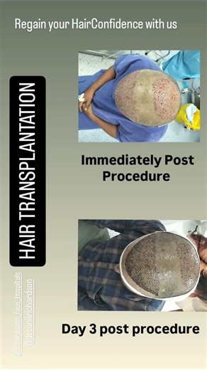 Hair Transplant at Richardsons face hospital