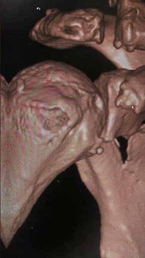 Understanding Your Scapula Fracture X-Ray #scapula #trauma #shoulderinjury