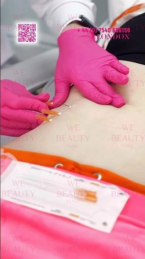 Stomach lift with mono threads 💥