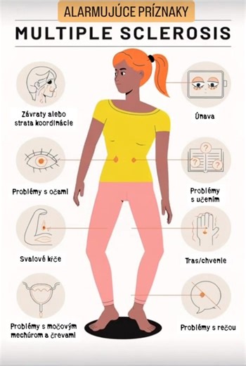Neprehliadnite varovné signály – vaše telo s vami hovorí Skleróza multiplex sa často začína nenápadne. Mierne závraty, únava, tras rúk, rozmazané videnie… drobnosti, ktoré si človek ľahko vysvetlí stresom, prepracovaním alebo únavou. No ak sa tieto príznaky opakujú alebo pribúdajú, telo vysiela jasný signál, že niečo nie je v poriadku. SM nepostihuje len telo – ovplyvňuje aj myseľ, rovnováhu, pamäť, reč, koordináciu či schopnosť udržať moč a kontrolovať pohyby. Prvé symptómy môžu byť premenlivé,