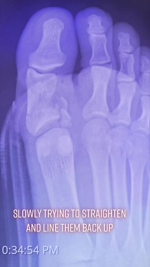 Slow process to straighten and line the bones up