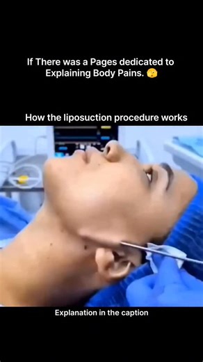 Explaining Biology on Instagram: "Jawline liposuction is a minimally invasive cosmetic procedure designed to remove excess fat from beneath the chin and along the jawline. During the process, a small cannula is inserted through tiny incisions, gently breaking down and suctioning out fat cells. Once removed, these fat cells do not grow back, allowing the jawline to appear sharper and more defined. The procedure helps enhance facial symmetry, improve contour, and reduce the appearance of a double