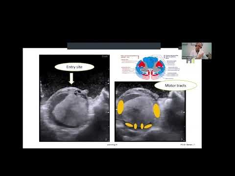 Spinal tumors - the good, the bad and the ugly