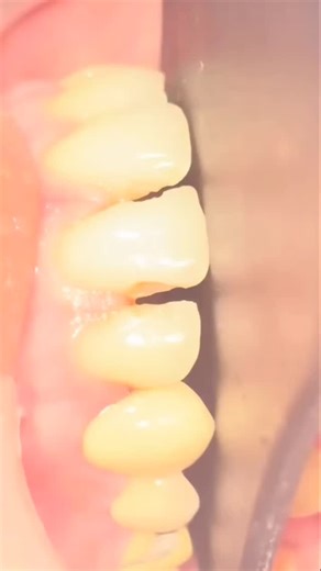 Step-by-step guide on direct composite build-up for anterior teeth restoration and smile designing: Pre-Treatment Planning 1. Consultation: Evaluate the patient's smile and discuss treatment options. 2. Shade selection: Choose the appropriate composite resin shade. 3. Photography: Take pre-operative photos for documentation. Step 1: Preparation 1. Anesthesia: Administer local anesthesia if necessary. 2. Isolation: Use rubber dam or cotton rolls to isolate the tooth. Step 2: Tooth Preparation 1. 