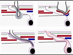 Inguinal hernia DR. SAMEH GHAZY