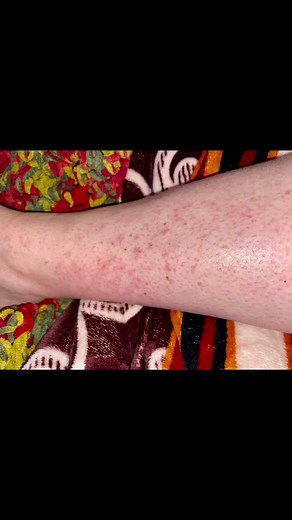 Vancomycin Rash and Sepsis Concerns