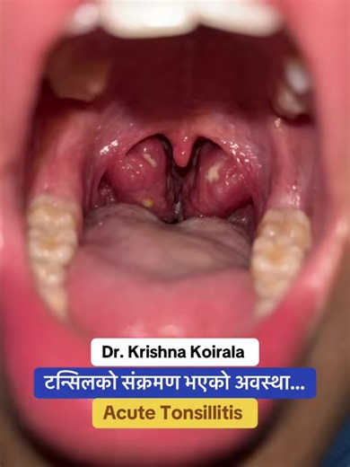 Tonsillitis: Understanding Throat Pain Symptoms