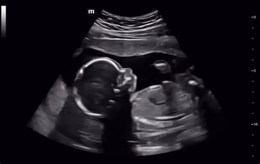 As they get bigger, the movements becomes more frequent ❤️ . Pregnancy Scan now costs N10,000 @FeetalHospital . We also offer these Important Investigative Scans; . °Nuchal Translucency Scan (11-13weeks) °Breast Scan °Neck Scan °Pelvic Scan °Abdominal Scan °Prostate Scan for Men °Testicular Scan for Men °Anomaly Scan (18-25weeks) °BioPhysical Profile Scan (33 weeks) °Fetal Sex determination scan °Follicular tracking scan °Fetal Activity Scan . And all others advanced ultrasound scans @ affordabl