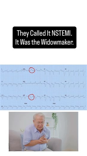 Learn ECGs Fast | JMD Medical Ed on Instagram: "He’s in his 50s Collapsed in triage. Skin grey, soaked in sweat. BP unreadable. You hit print, and your hands start shaking before the paper finishes rolling out. Widespread ST depression. V2 to V6 sinking. Leads I, II, and aVF collapsing under invisible weight. And then a cruel twist lead aVR rises. Three millimetres of rebellion. ST elevation that looks small… until you realise it’s the only mountain left standing. That’s not a random pattern. Th