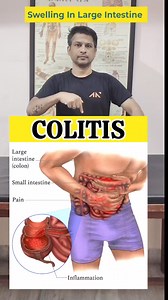 61K views · 788 reactions | Best Exercise for COLITIS (swelling in large intestine) Relief #shorts #tranding | Dr.Nishant Gautam | Facebook