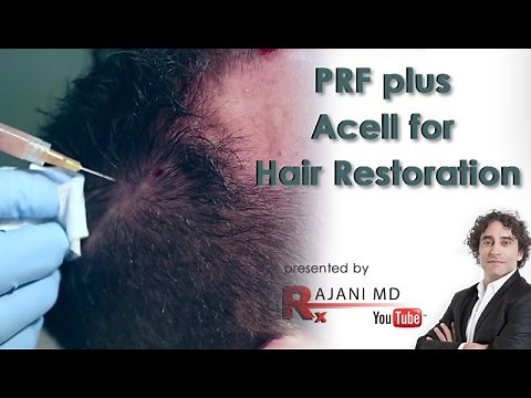 PRF plus Acell for Hair Restoration-Dr Rajani