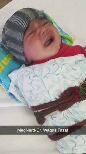 Inspiratory Stridor in an infant with Laryngomalacia.