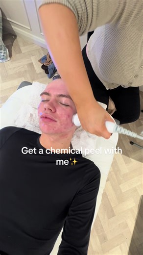 Experience My First Chemical Peel Journey