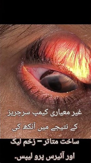 Collapsed anterior chamber with iris prolapse — a sight-threatening complication.