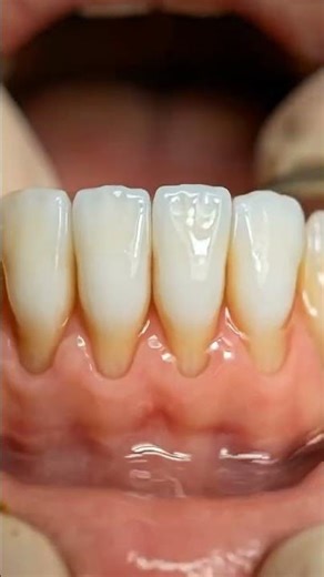 These Teeth Were Absolutely Disgusting #beforeandafter #cleaning