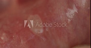 Macro shot of a injury in the mouth called Aphthous stomatitis or canker sores. Small blood vessels visible, swelling of the tissue visible.