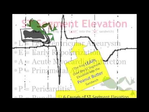 Teaching 12 Lead EKG: STEMI or early repol?