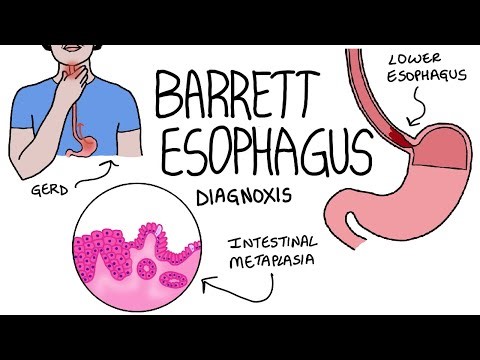 Barrett esophagus- causes, pathogenesis, morphology(gross and microscopy)
