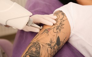 Tattoo Removal - Broward Dermatology