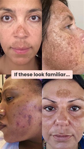 Real patients, real results! Transform your skin with The Spot Cream ✨ Formulated by board-certified dermatologists, this treatment contains clinically proven ingredients like Hydroquinone, Tretinoin, Niacinamide, and Vitamin C. Get started today at Musely.com and have The Spot Cream delivered directly to your doorstep! | Musely