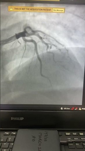 Normal coronary angiogram.