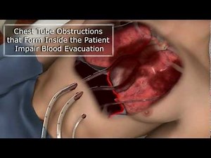 How to Prevent Chest Tube Occlusion - PleuraFlow ACT