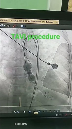 tavi procedure