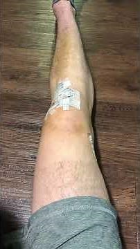 Quad Sets / Isometric Contractions - ACL Rehab Exercises