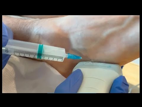 Ultrasound Guided Corticosteroid Injection for Peroneal Longus Tendon Pain in Runner with Foot Pain