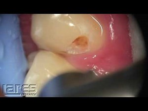 Class V Laser Cavity Preparation, Tipless Handpiece - Lares PowerLase AT Laser Dentistry