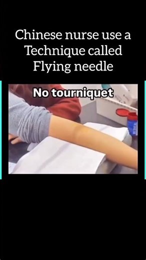 Chinese nurse use a technique called flying needle
