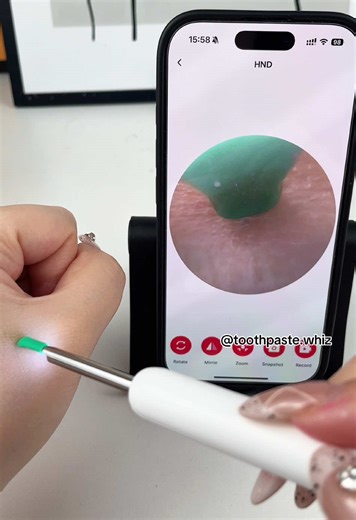 $10 ONLY TODAY!!!#fyp #US #foru #tiktokmademebuyit #life #tiktikshop #safe #ear #earwax #earwaxremoval