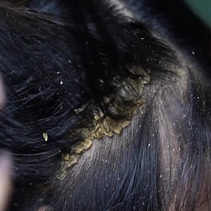 22K views · 62 reactions | SCRATCH my dandruff PLEASE! Part 2 | toktok.tv | Facebook