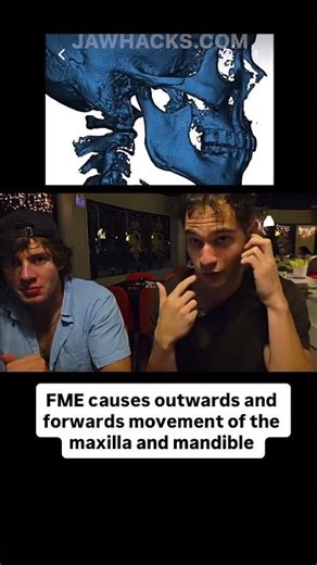 FME advances the mandible and maxilla