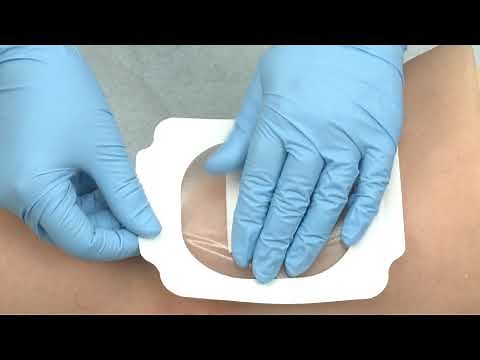 Mepitel® Film - Anwendungsvideo - Mölnlycke Health Care
