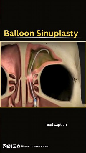 Balloon sinuplasty 🎈👃