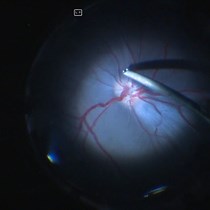 Video: Subretinal Implantation of RPE on a Carrier in Minipigs: Guidelines for Preoperative Preparations, Surgical Techniques, and Postoperative Care