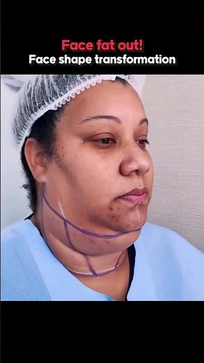 Double Chin Liposuction: Real Before & After Results