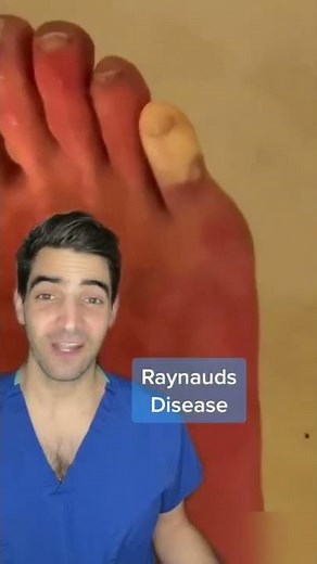 Raynauds disease