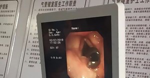 Gone Viral: Doctors remove 3-cm long live leech from woman’s throat [VIDEO]