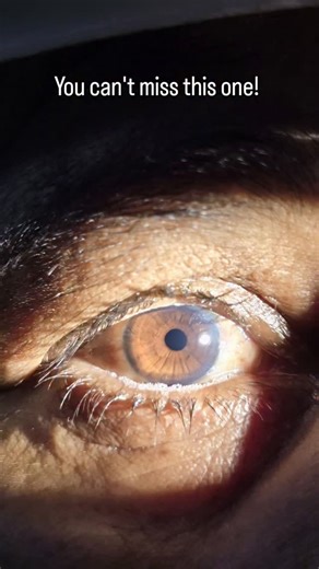 Eyelogy on Instagram: "👁️ Can you spot the finding? Foamy tear film. Thickened lid margins. Something’s off at the lash line… 👉 This is Meibomian Gland Dysfunction (MGD) A chronic disorder of the meibomian glands causing abnormal lipid secretion → evaporative dry eye. 🧠 Look closely for: • Frothy / bubbly tear film • Capped orifices at lid margin • Thick, toothpaste-like meibum • Lid margin telangiectasia 🔍 Why it matters: • Most common cause of dry eye disease • Often under-diagnosed • Wors