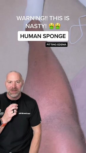 Pitting Edema: Causes, Symptoms & Treatment