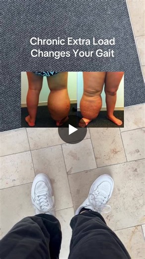 Lymphedema Compensation Patterns and Retraining | Amy Rivera posted on the topic | LinkedIn