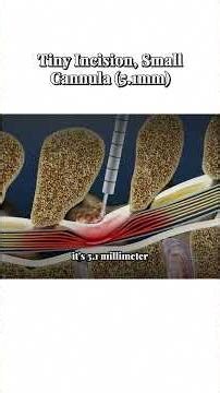 15 Minutes to Relief: The MILD Procedure for Spinal Stenosis ⏱️