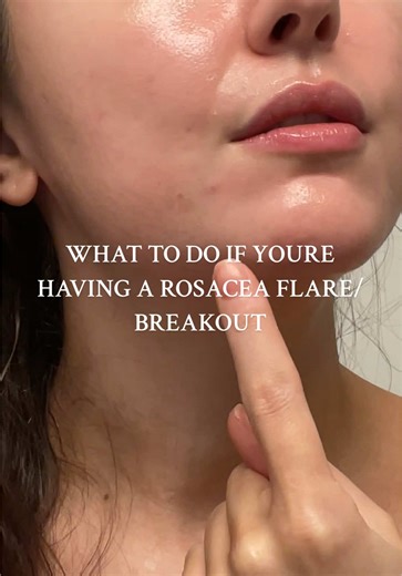 How to Treat a Rosacea Breakout Effectively